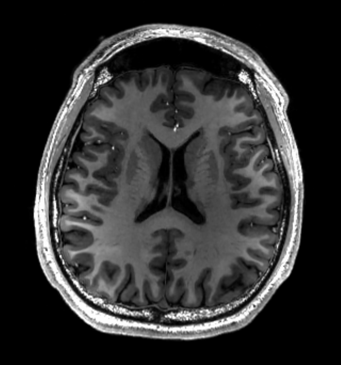 MRI