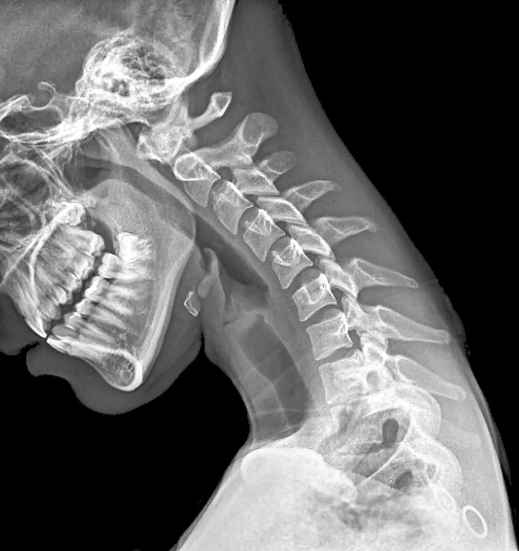 X-Ray